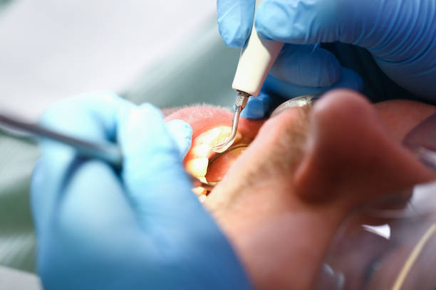 Best Emergency Tooth Extraction in Adrian, MI